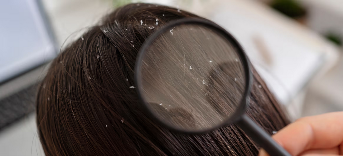 Does Dandruff Cause Hair Loss?