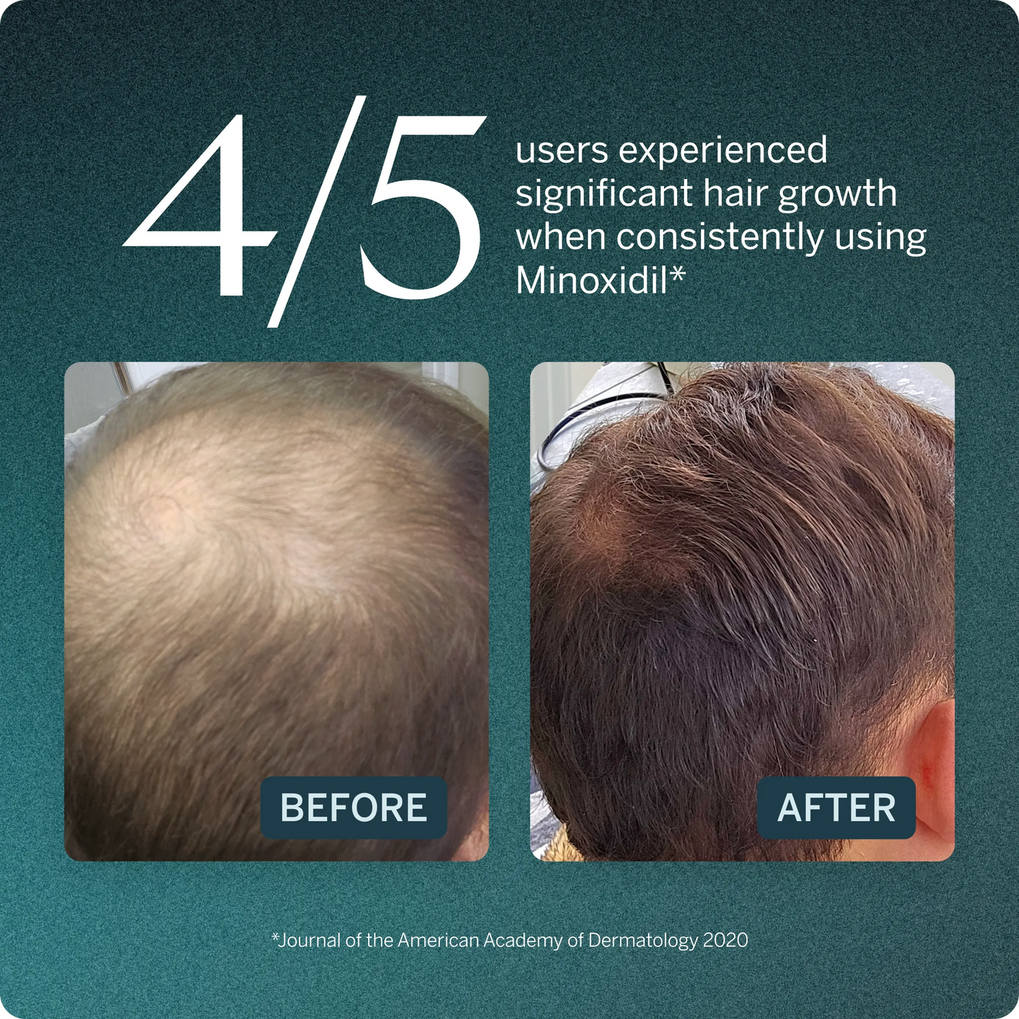 5% Minoxidil Topical Solution, USP (Extra Strength)