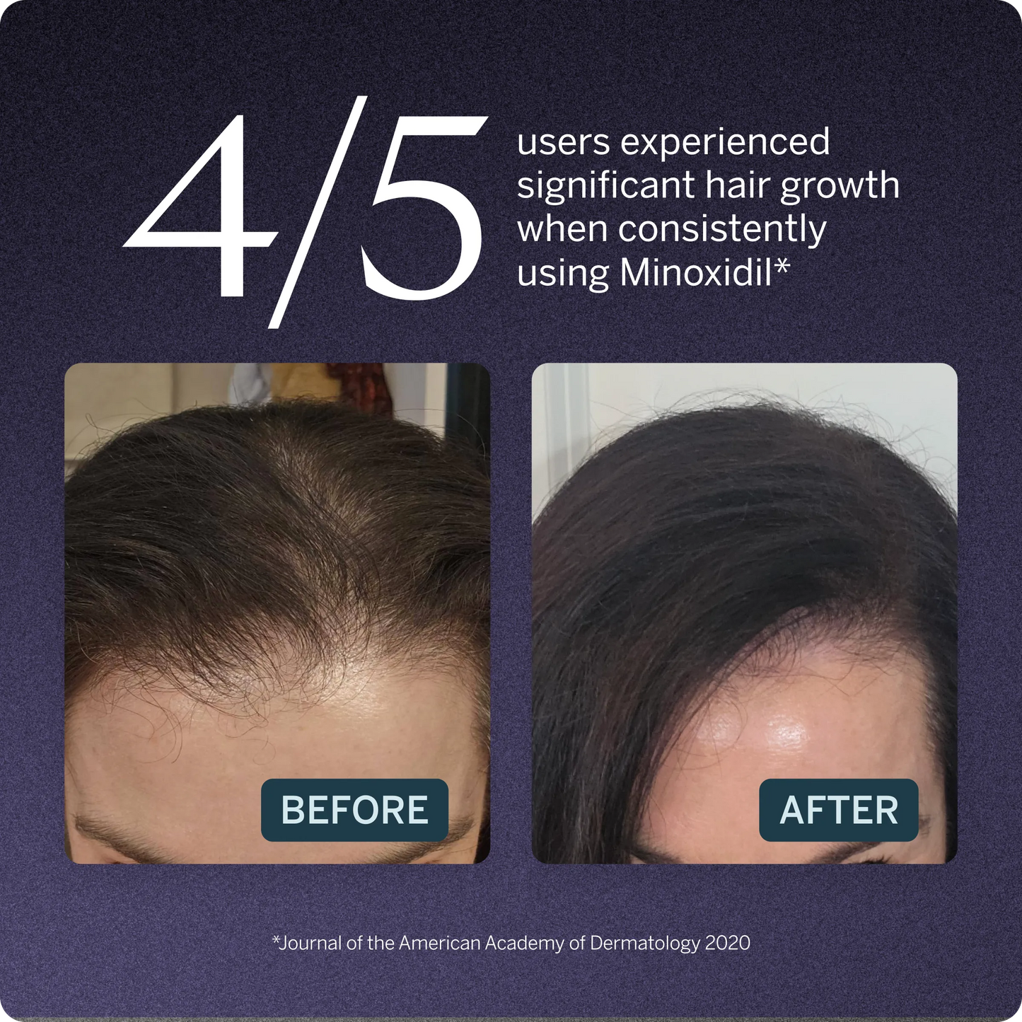 2% Minoxidil Topical Solution, USP
