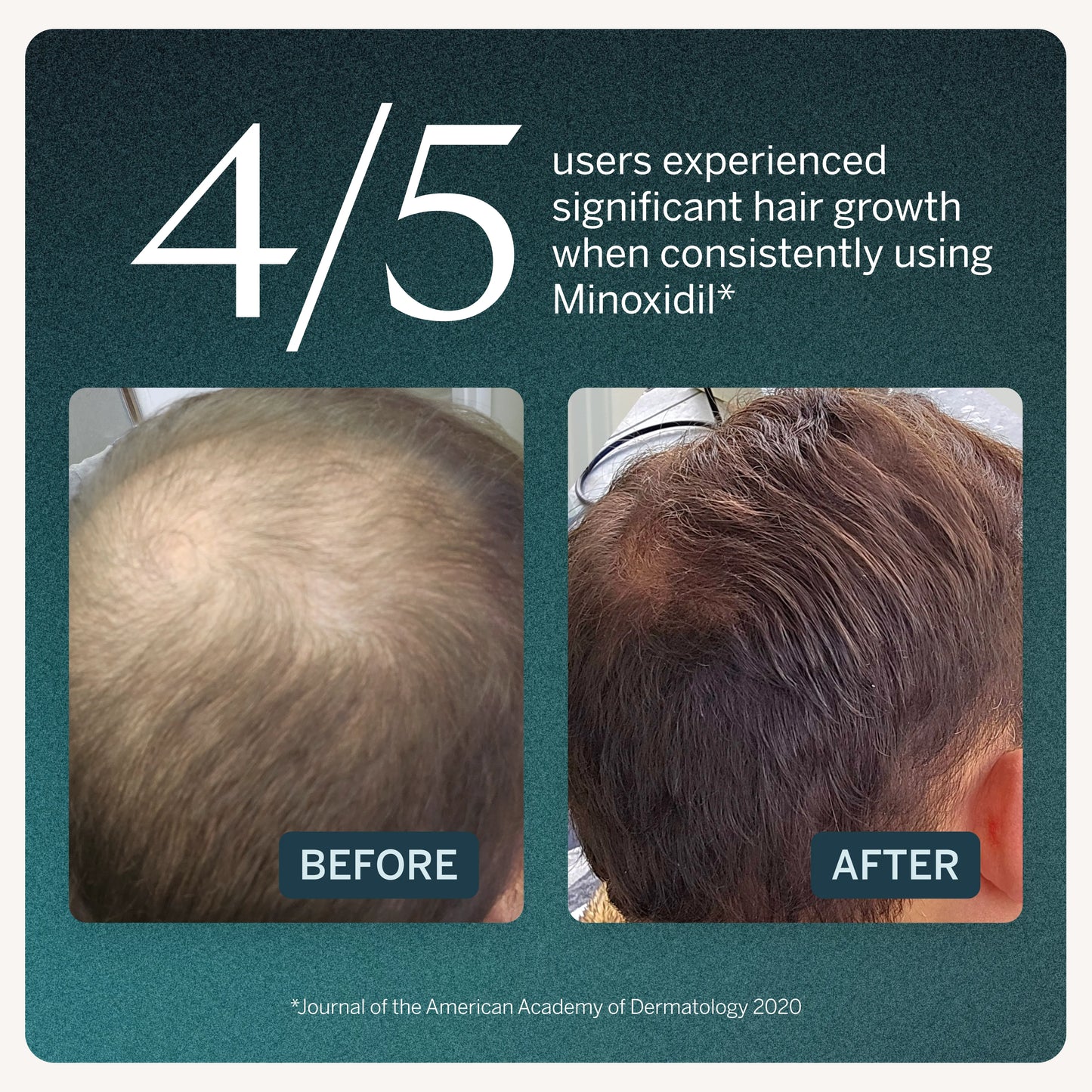 5% Minoxidil Topical Solution, USP (Extra Strength)