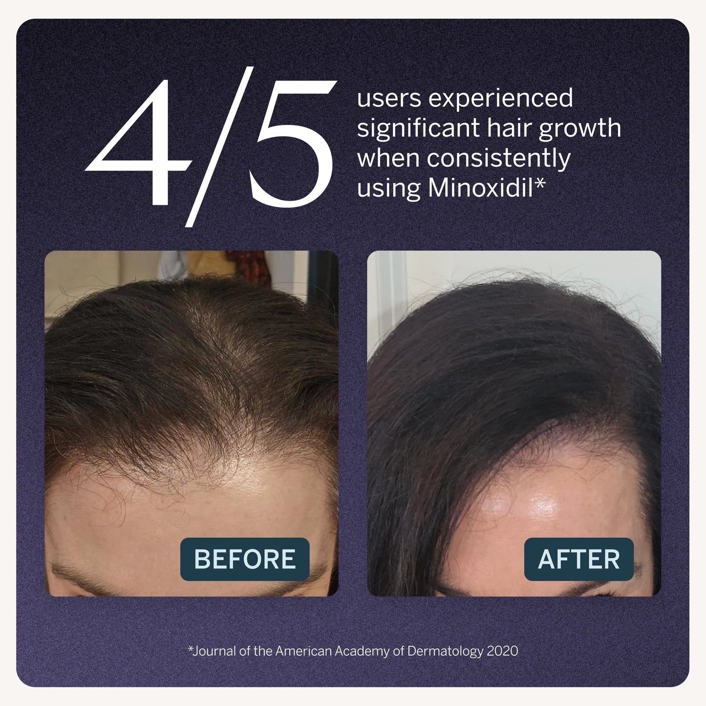 2% Minoxidil Topical Solution, USP